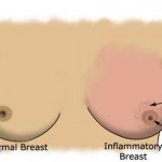 Secondary Breast Cancer