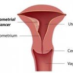 Image showing Endometrial Cancer