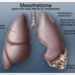 Mesothelioma Cancer, Claims & Compensation